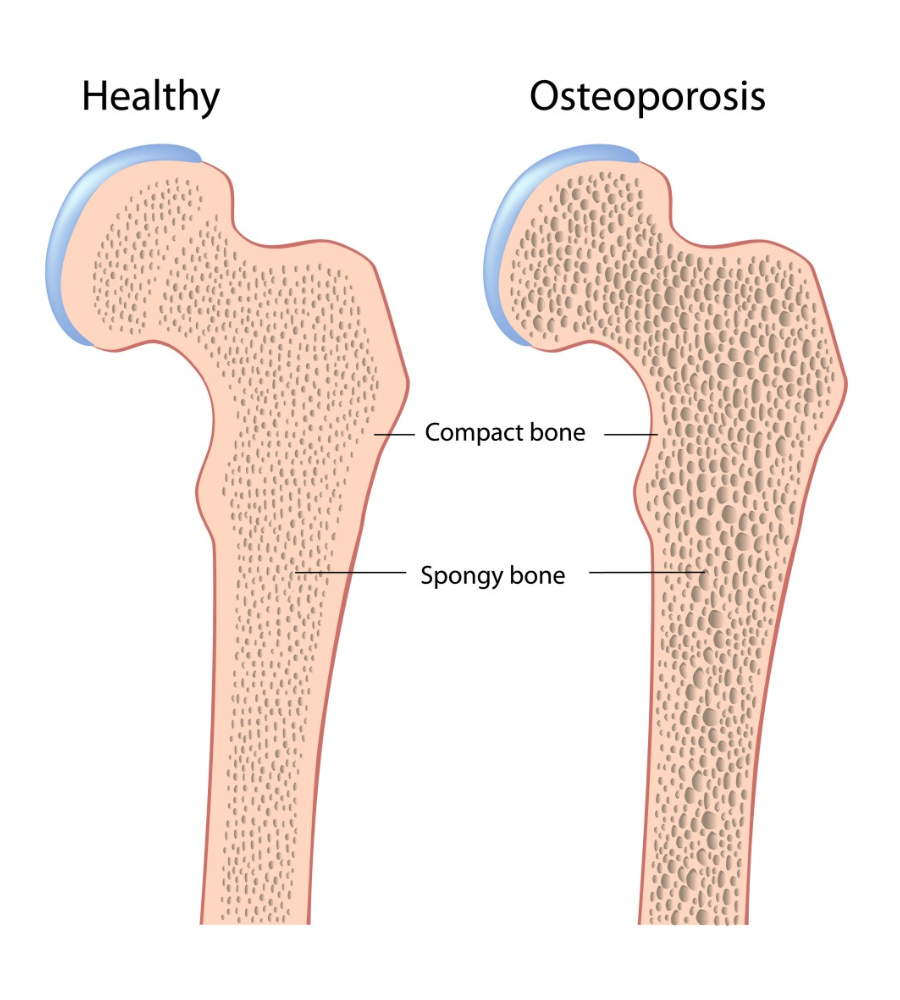 Osteoporosi: raffigurazione di un osso sano e uno malato