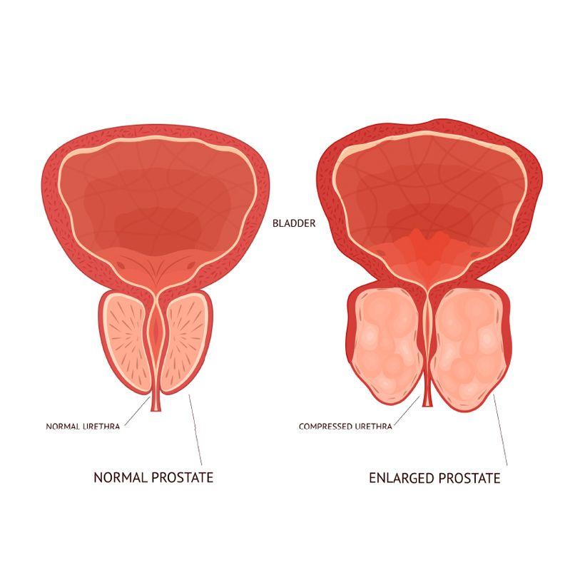 Prostatite batterica: illustrazione di confronto fra una prostata normale e una malata