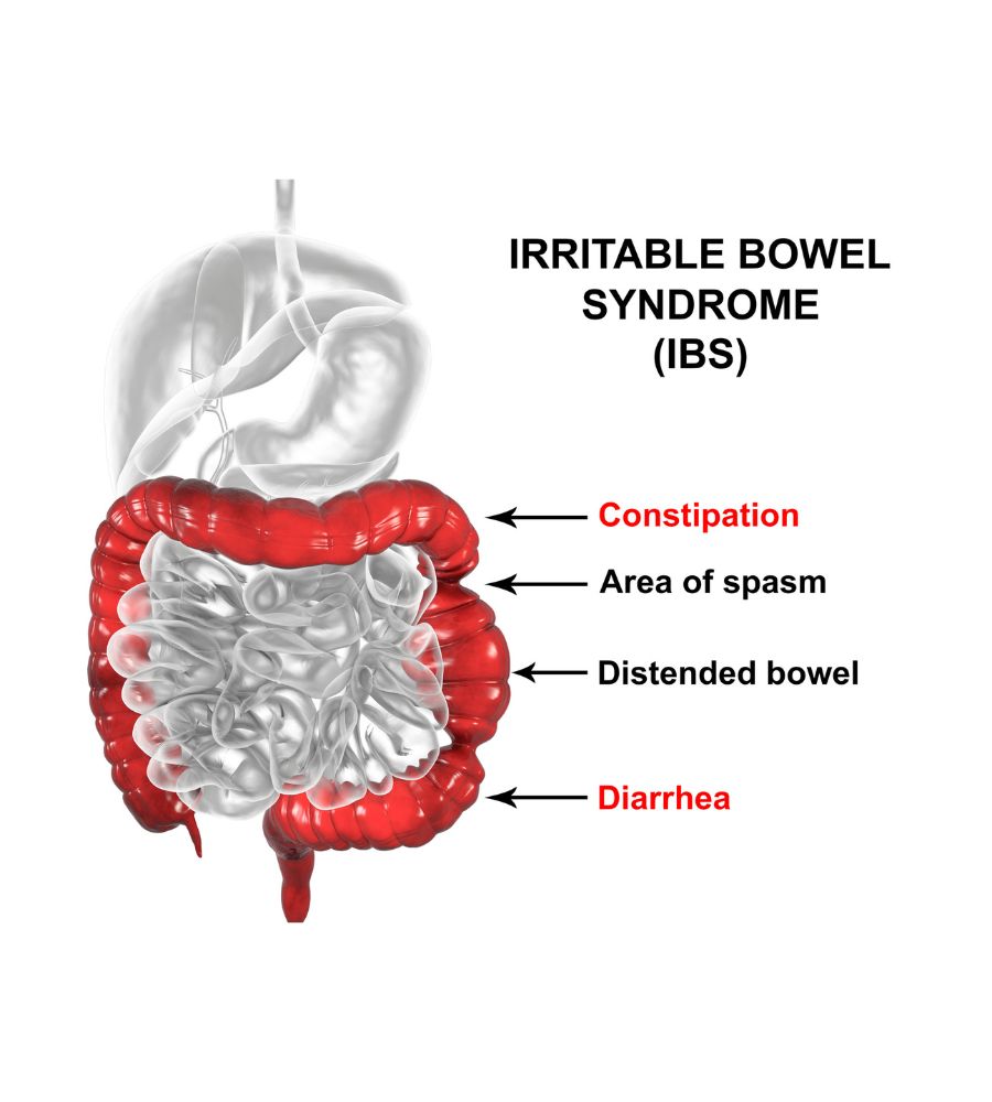 Immagine che rappresenta i sintomi del colon irritabile