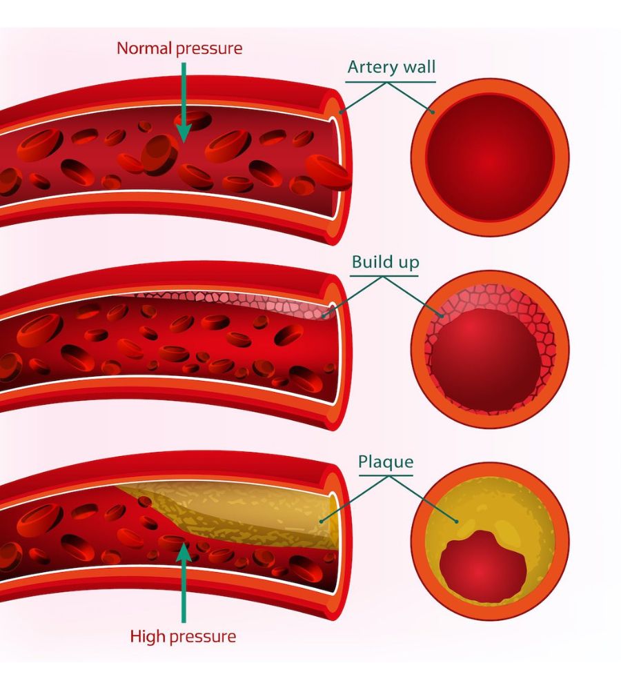 Pre-ipertensione: illustrazione di confronto fra condizioni di elevata e normale pressione sanguigna